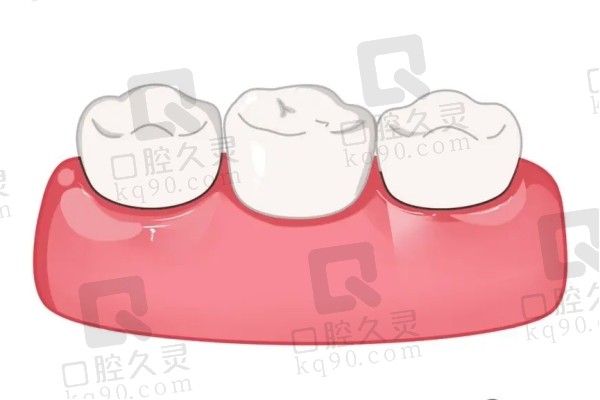 戴上牙冠