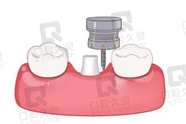 打磨基牙