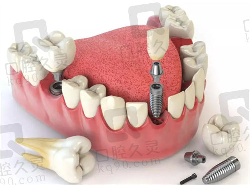 青岛种植牙比较好的口腔医院有哪些？