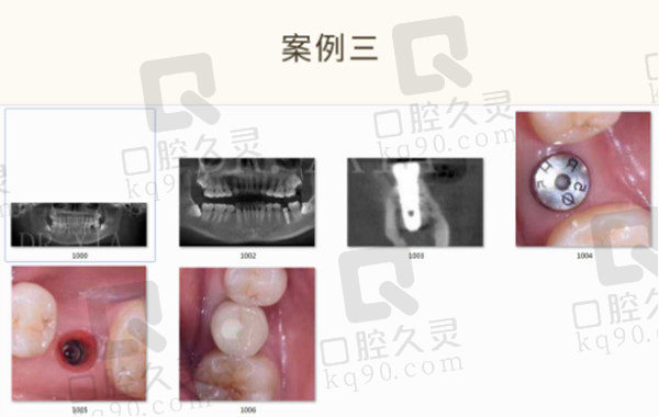 种植病例三