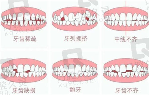 苏州牙齿矫正一般多少钱？