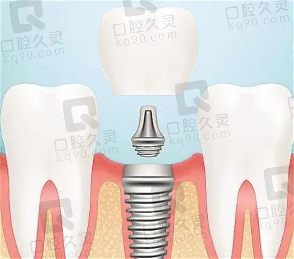 种植牙的作用