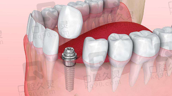 种植一颗牙的整体费用