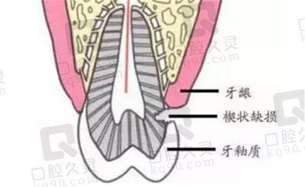 牙齿楔状缺损解析图