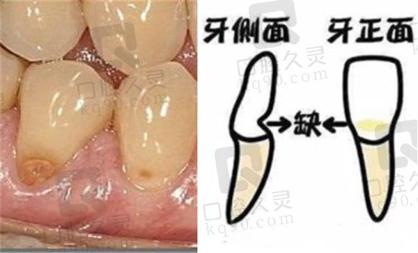 牙齿楔状缺损