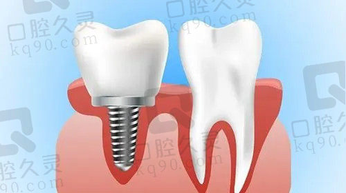 厦门种植牙价格