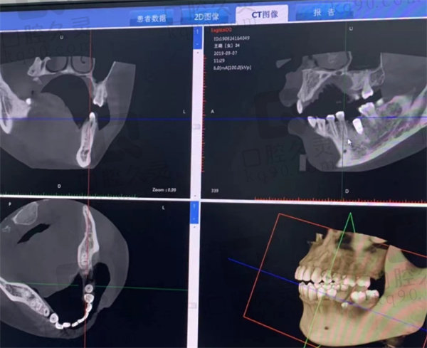 口腔CT图