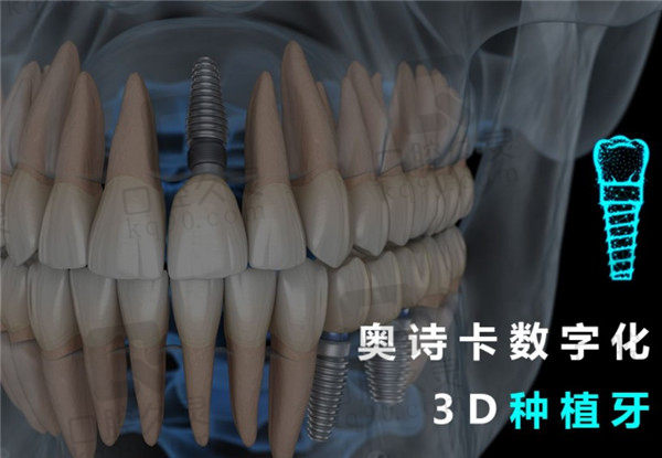 汕头奥诗卡口腔种植牙技术先进