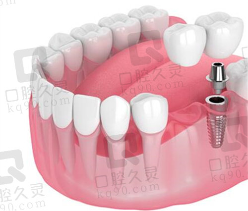 北京劲松口腔种植牙