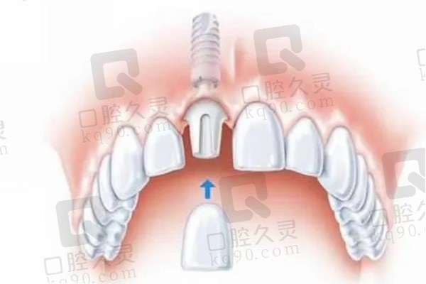 单颗种植牙