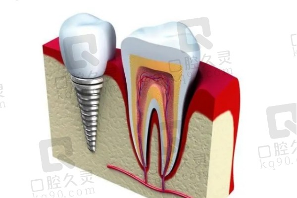 种植牙与真牙结构对比