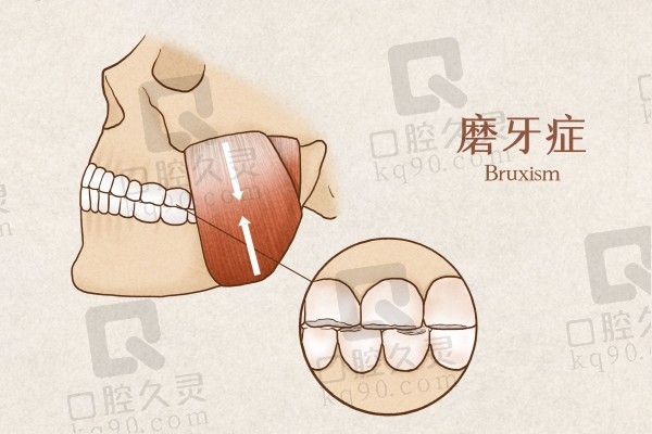 儿童磨牙症