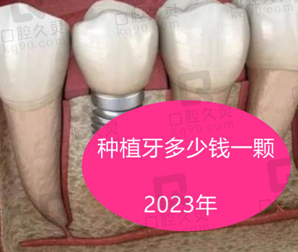 种植牙多少钱一颗2023年