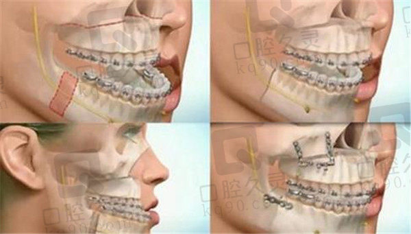 张士杰院长正畸正颌联合治疗手术