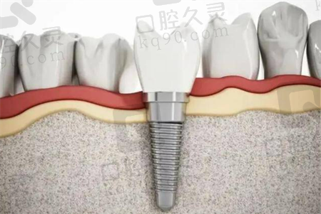 内蒙古赤峰忠冠口腔种牙