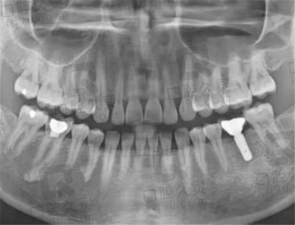 杭州杭数口腔种植牙后