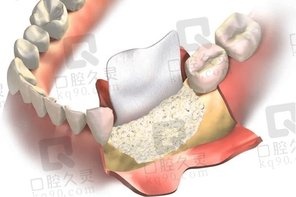 种牙骨粉骨膜结构