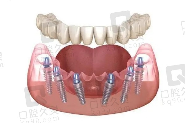 all-on-6半口种植牙