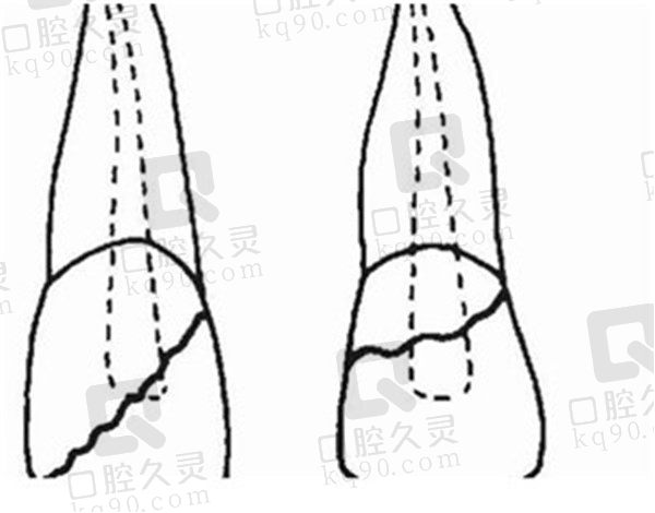 根折