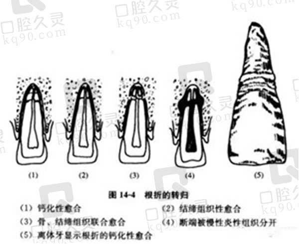 牙折恢复方式