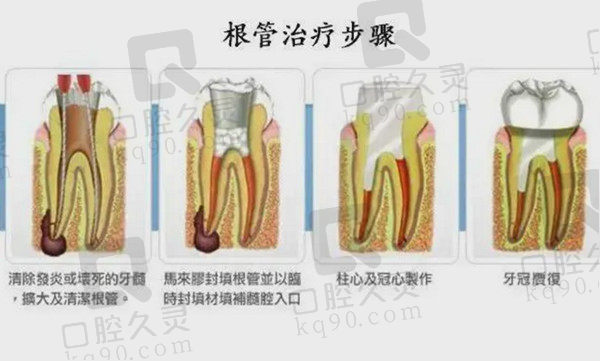 根管治疗