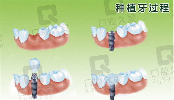 种植牙过程