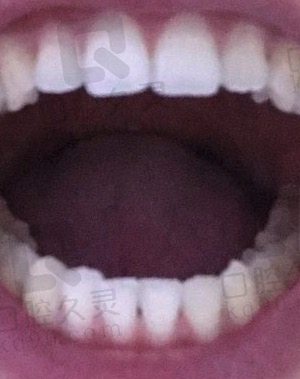 牙片