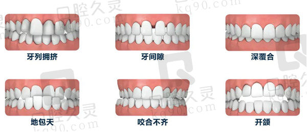 牙齿矫正