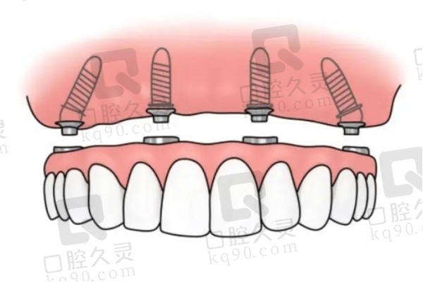 all on 4种植牙上颌