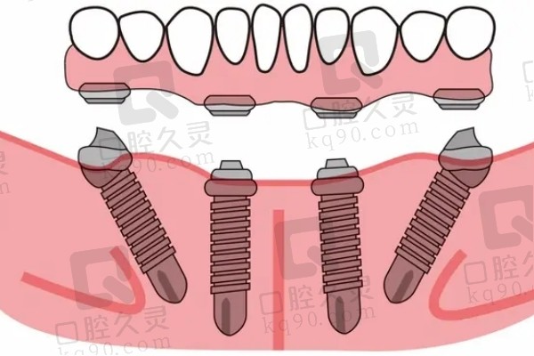 all on 4种植牙下颌