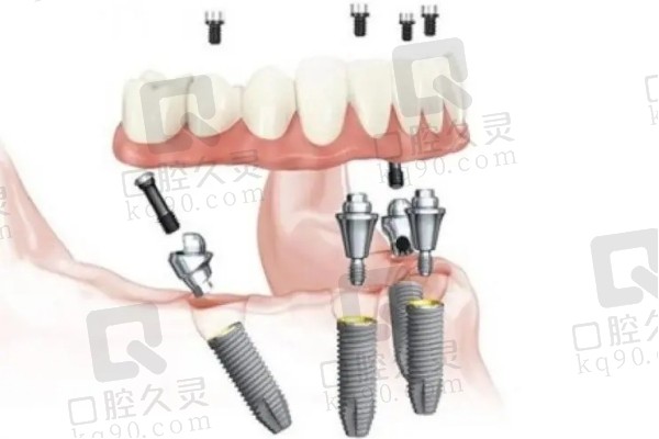 all on 4种植牙示意图