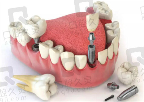 娄底口腔医院种植牙怎么样？