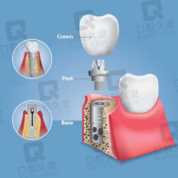 种植牙结构