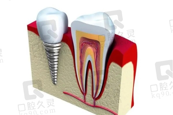 种植牙与真牙结构对比