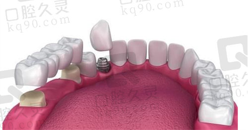 牙齿缺失通常采用种植牙修复