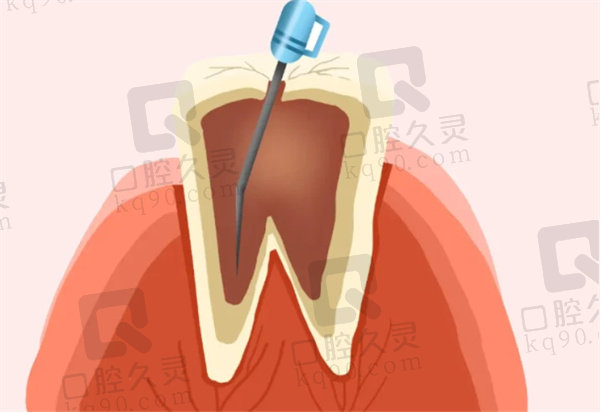 根管治疗