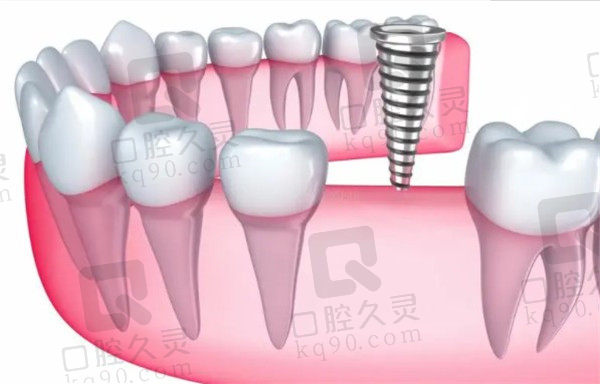 种植牙2