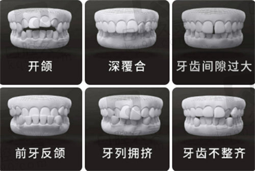 哪些人需要牙齿矫正