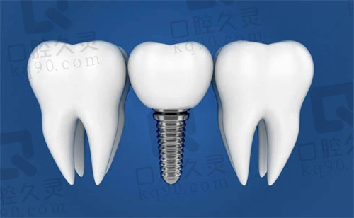 青岛牙博士口腔种植牙示意图