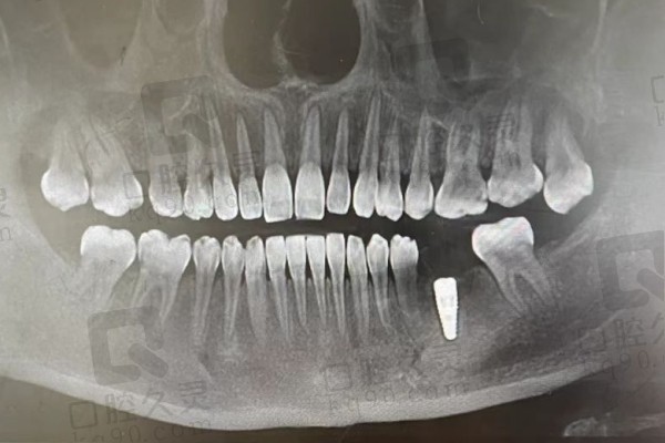 湛江珠江口腔医院种牙牙片