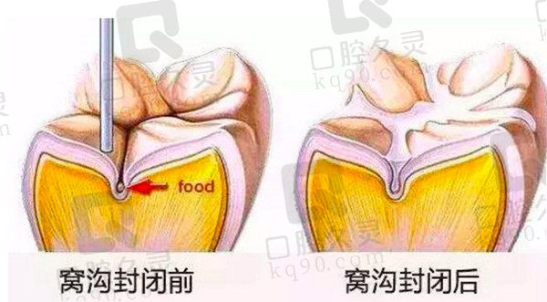 窝沟封闭