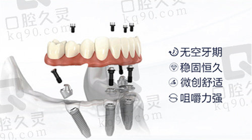 贵阳牙博士口腔医院种牙技术怎么样