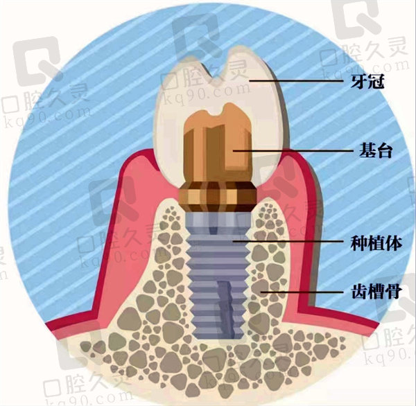 种植牙解剖图