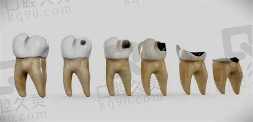 牙齿龋坏侵蚀牙体的不同程度