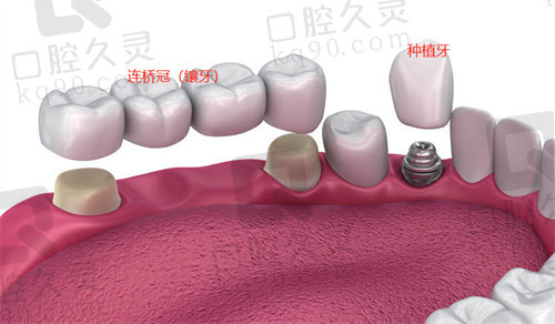 种植牙和镶牙冠有着不同的适应症