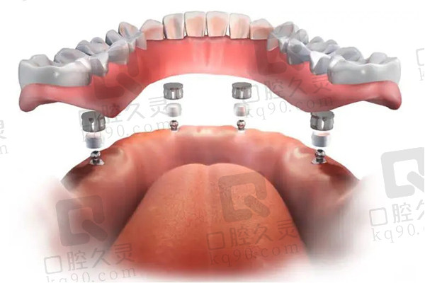 湘潭唯雅口腔医院半全口种植技术好
