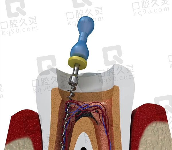 牙神经去除过程