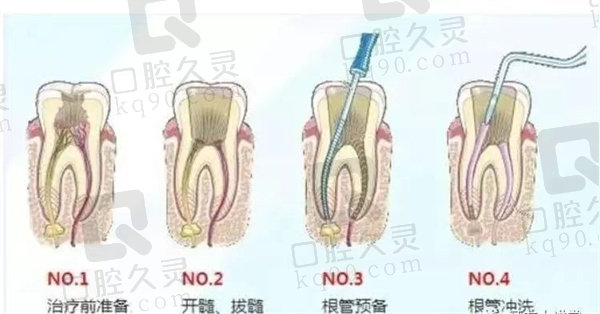 牙神经去除图