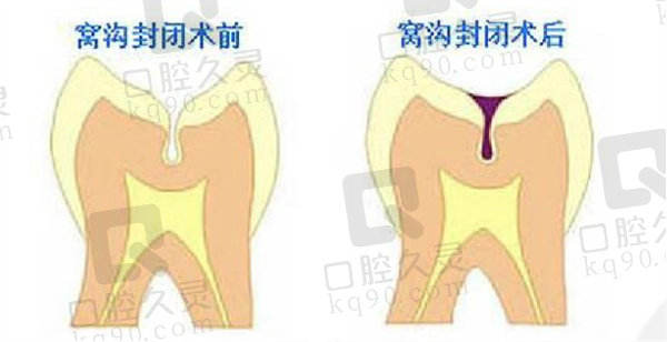 儿童窝沟封闭解剖图