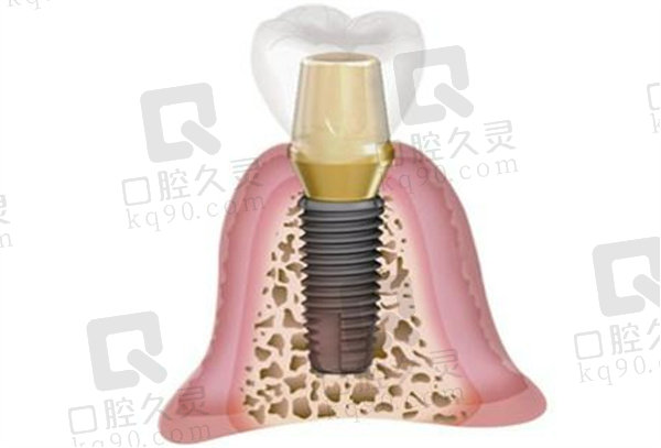 种植体解剖图